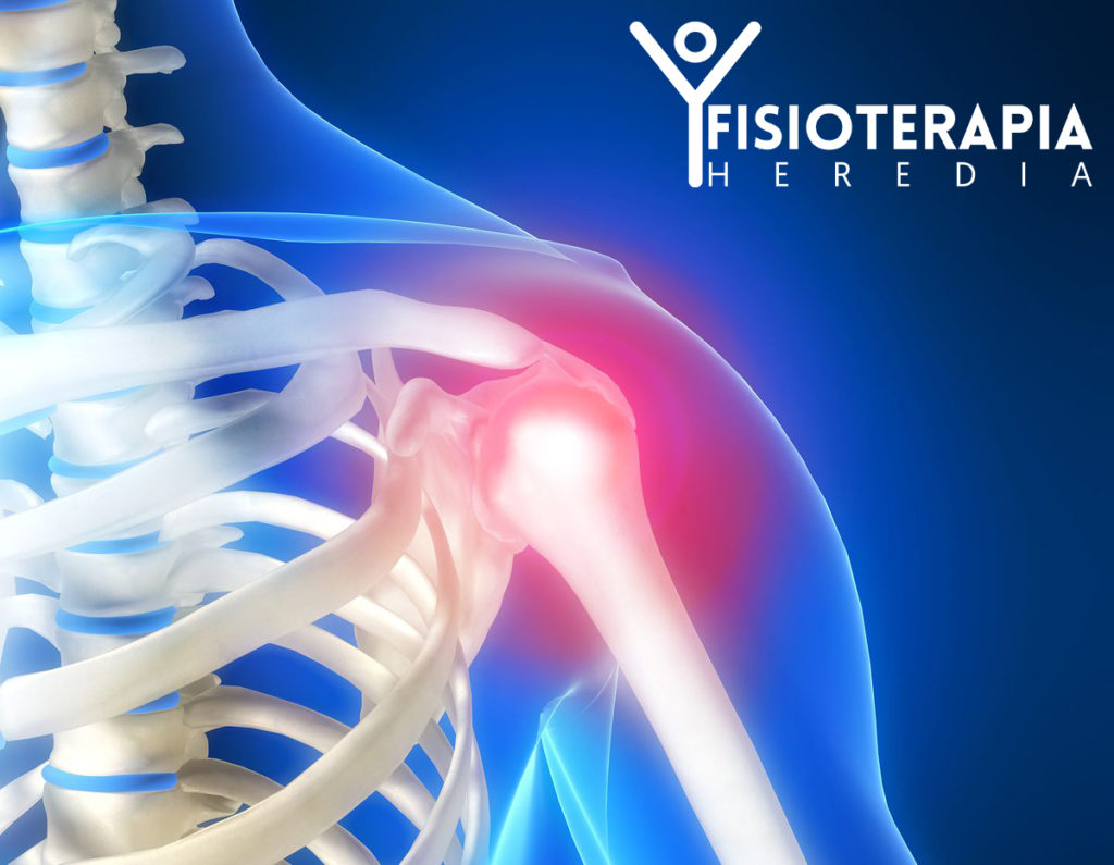 Lesiones Principales De Hombro: Artrosis - Fisioterapia Heredia